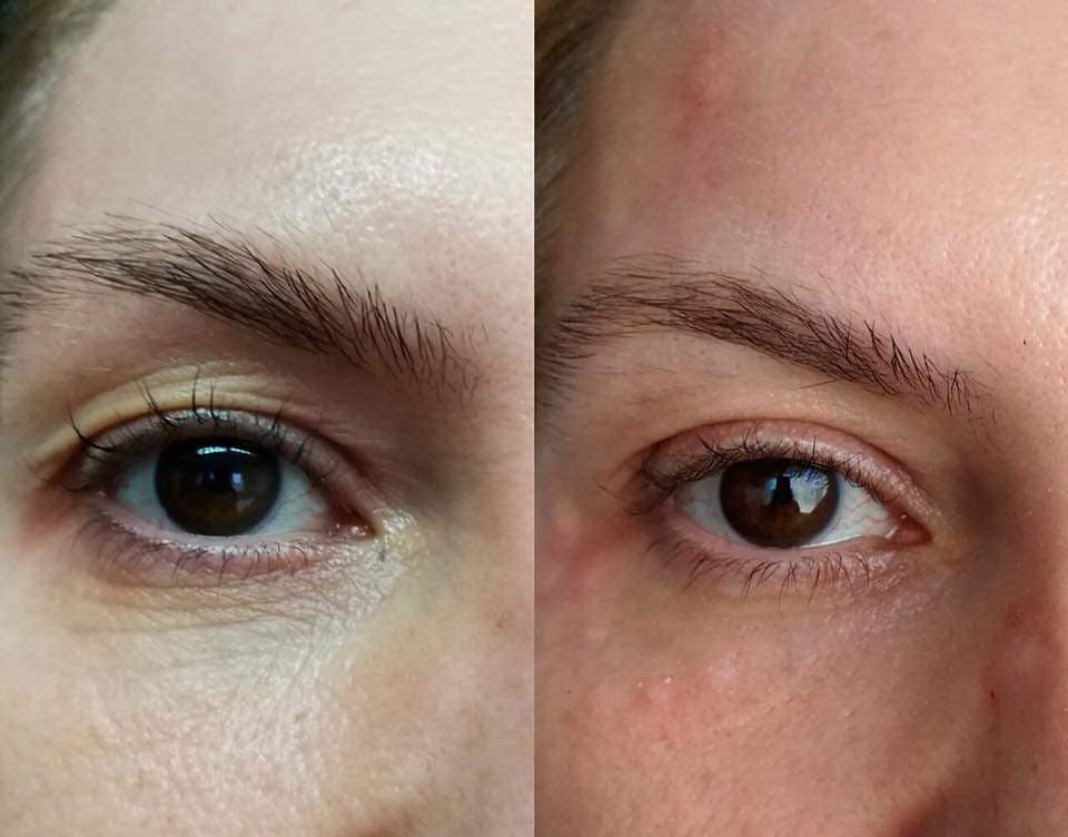 Manufacturer-provided example of eyelid tightening before and after treatment