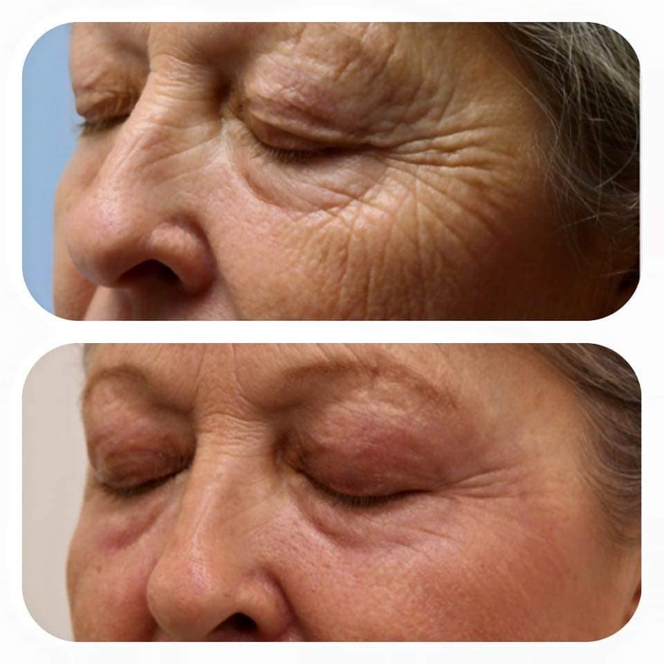 Manufacturer-provided example of PLEXR wrinkle treatment before and after treatment